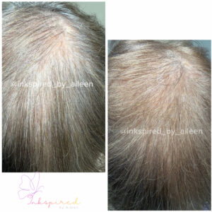 Follicure Hair Restoration