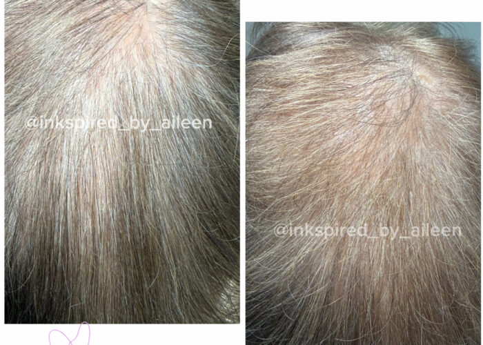 Follicure Hair Restoration