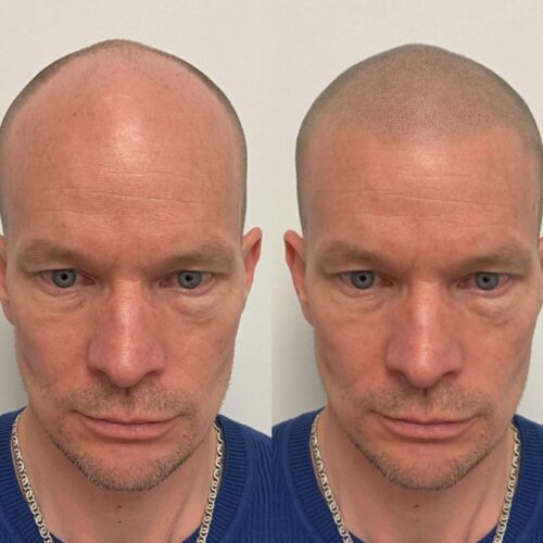 SMP PHOTO MOCK UP - SCALP MICROPIGMENTATION MOCK UP 1
