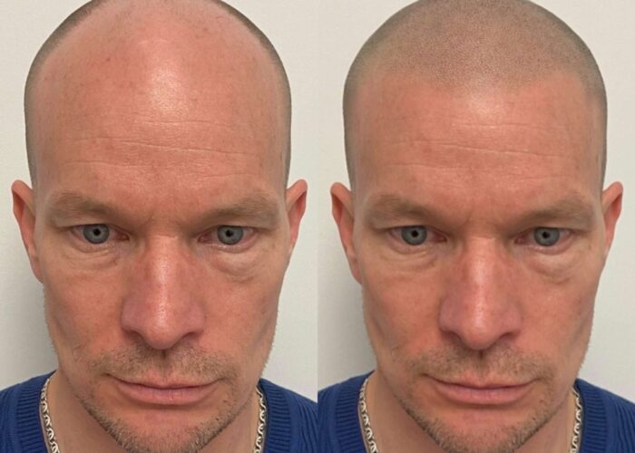 SMP PHOTO MOCK UP - SCALP MICROPIGMENTATION MOCK UP 1