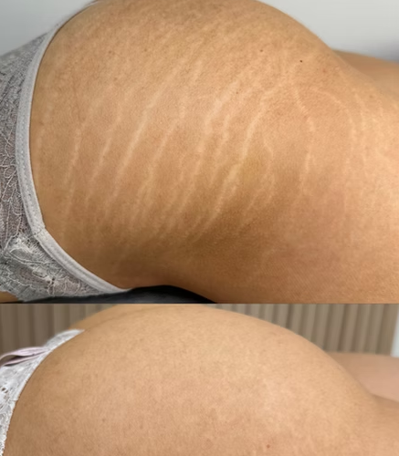 Scar Camouflage