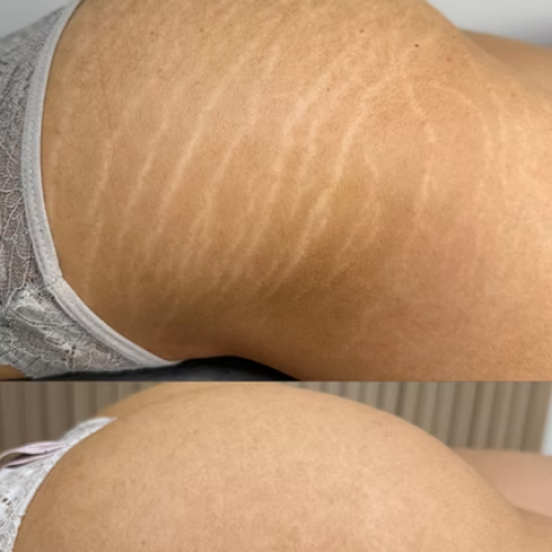 Scar Camouflage