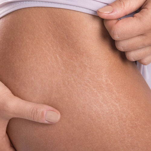 white-stretch-marks