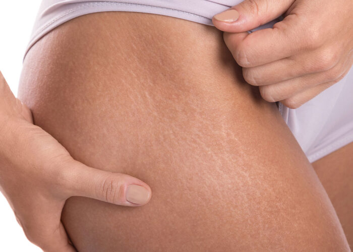 white-stretch-marks