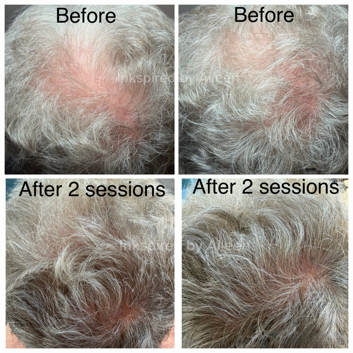 Follicure Hair Restoration before and after