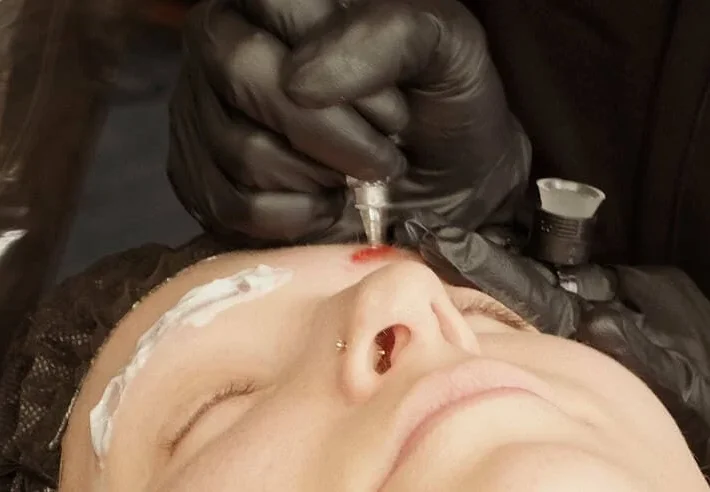 removal-saline