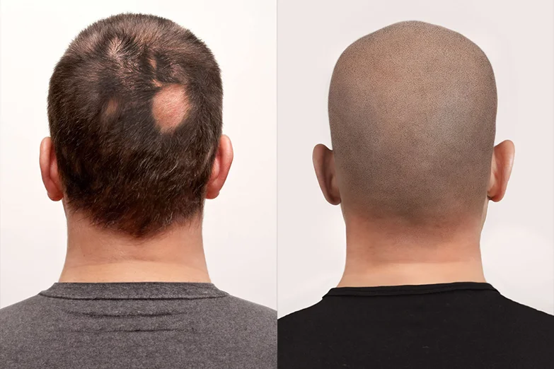 smp-alopecia-1